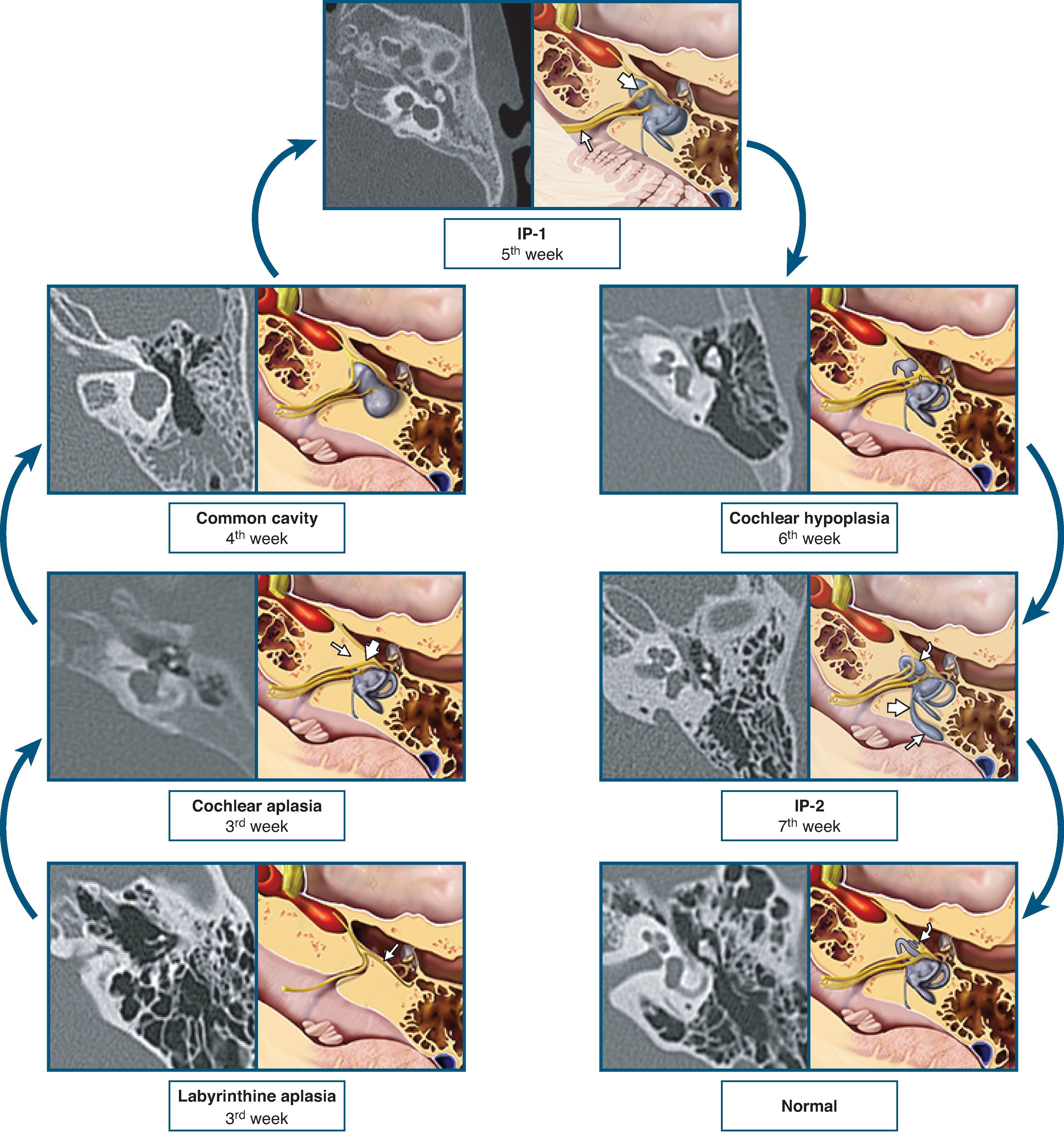 Fig. 13.3, The spectrum of inner ear malformation imaging findings reflects the timing of insult during gestation. Earlier insults lead to less formation of inner ear structures. (Illustrations from StatDX, Copyright © 2022 Elsevier.)