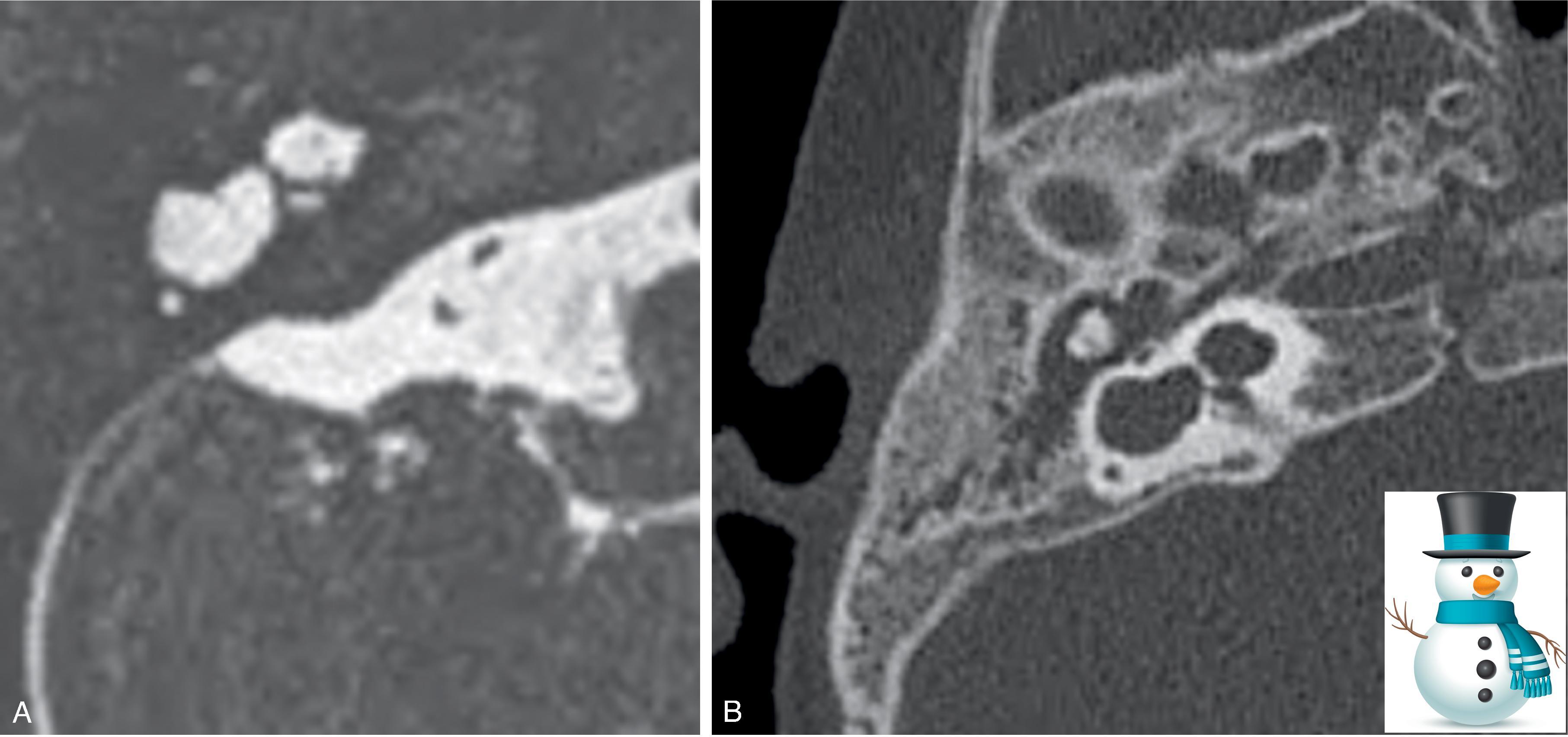 Fig. 13.4, Incomplete Partition Anomaly Type 1. (A) Axial T2W and (B) axial CT images demonstrate a cystic cochleovestibular anomaly with a “snowman” or “figure-8” morphology, absent interscalar septum, and absent modiolus. (B, inset image of snowman © istock.com/Vectorcreator.)