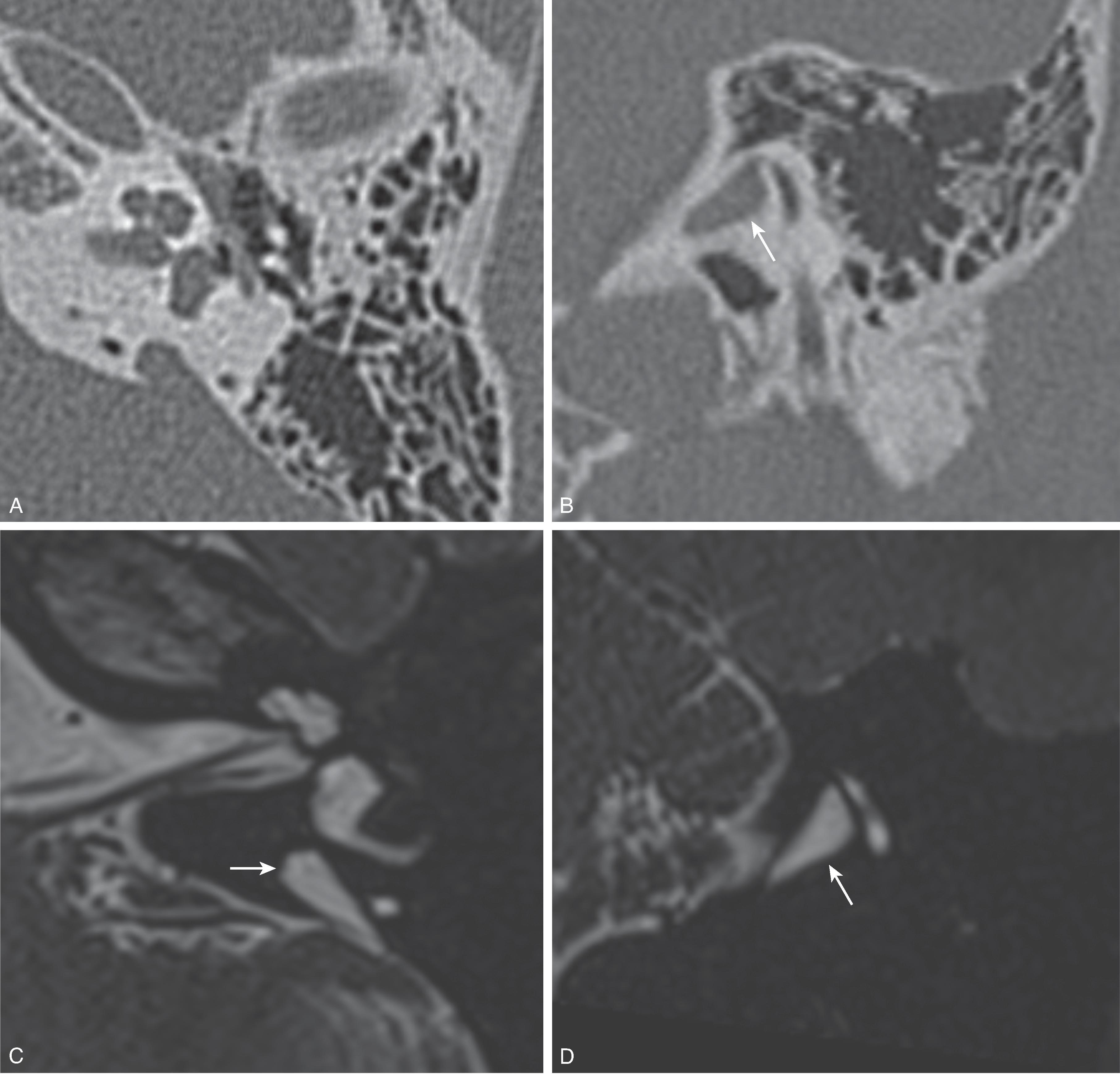 Fig. 13.5, Incomplete Partition Anomaly Type 2. (A and B) Axial and coronal 3DT2W CT and (C and D) axial images demonstrate malformation of the apical and middle turns of the cochlea and an enlarged vestibular aqueduct ( arrows ). A normal cochlear nerve is visible.