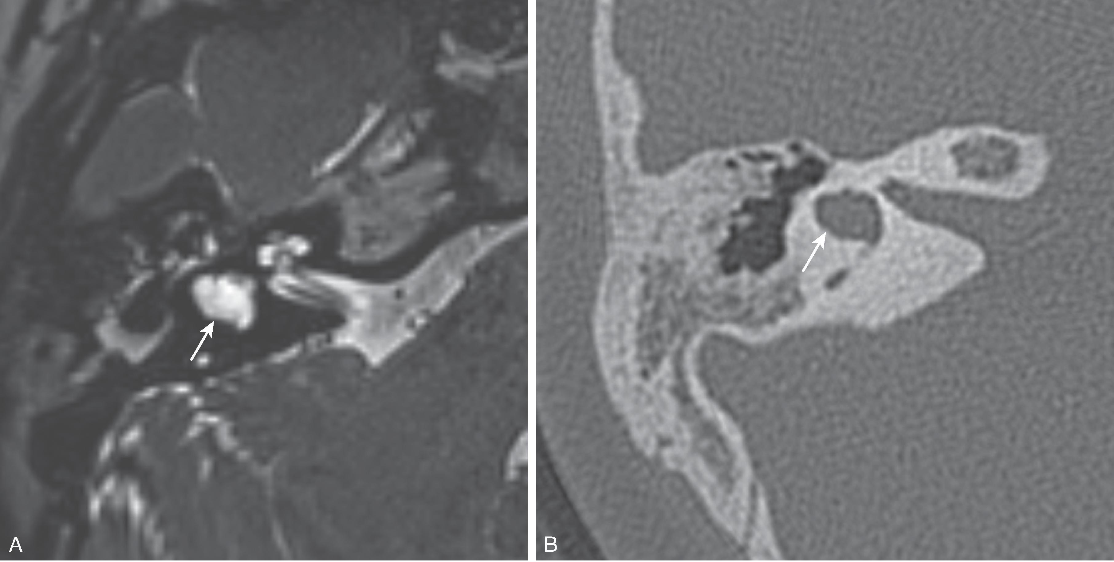 Fig. 13.6, Lateral Semicircular Canal Dysplasia. (A) Axial T2W and (B) axial CT images demonstrate malformation of the lateral semicircular canal ( arrow ) seen as lack of separation of the canal from the vestibule.