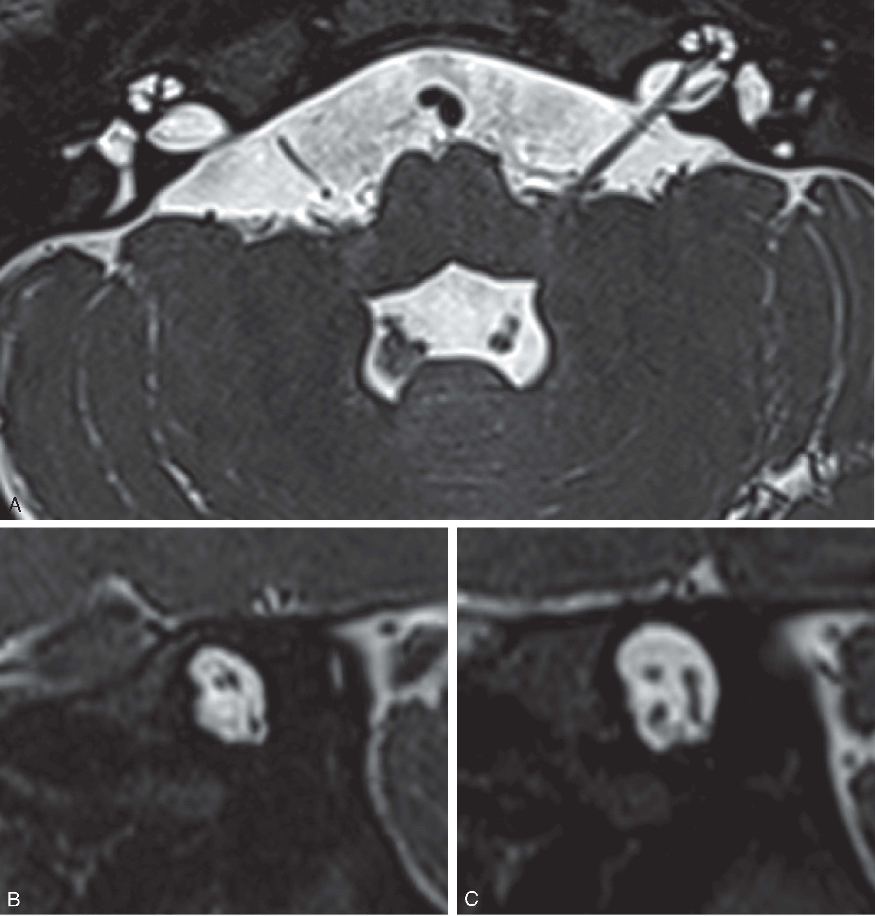 Fig. 13.8, Cochlear Nerve Hypoplasia. (A) Axial T2W, (B) right sagittal oblique T2W, and (C) left sagittal oblique T2W images demonstrate the lack of a right cochlear nerve beneath the facial nerve. Popular mnemonic “7 up, Coke down” refers to the normal appearance, which is cranial nerve 7 above and cranial nerve 8 below in the anterior aspect of the internal auditory canal.