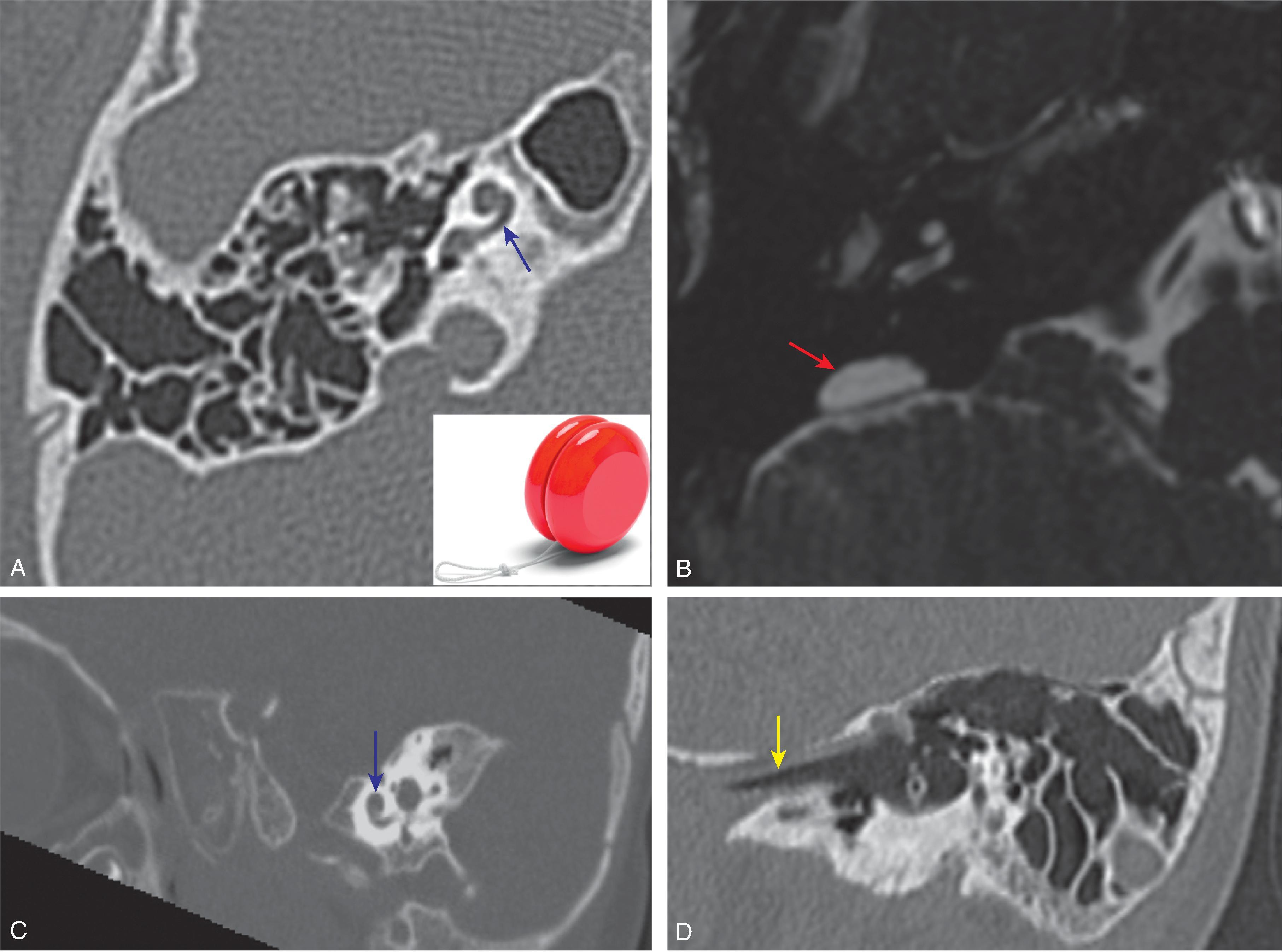 Fig. 13.9, Branchio-oto-renal Syndrome. (A, C, D) Multiplanar CT images and (B) axial T2W images demonstrate characteristic unwound cochlea ( blue arrow ), enlarged vestibular aqueduct ( red arrow ), and prominent eustachian tube ( yellow arrow ). (A, inset image of yo-yo © istock.com/Michael Burrell.)