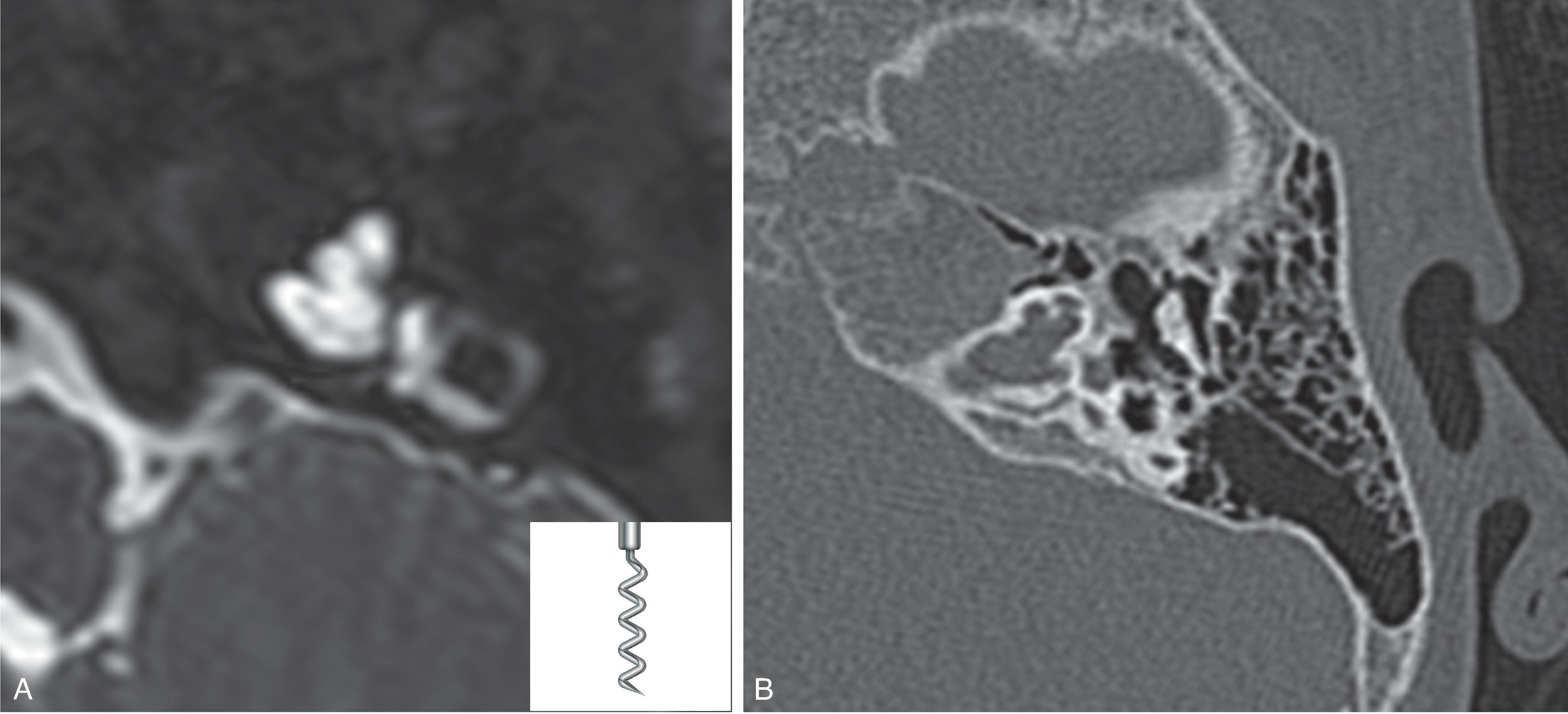 Fig. 13.10, X-Linked Deafness. (A) Axial T2W and (B) axial CT images demonstrate corkscrew malformation of the cochlea and absent modiolus. (A, inset image of corkscrew © istock.com/UASUMY)