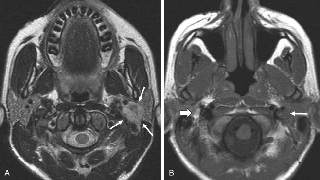 Fig. 6.1, Adenoid cystic carcinoma with perineural spread along the facial nerve in a 35-year-old woman with persistent and painful facial nerve palsy lasting for at least 6 months. (A) Axial T2-weighted MR image at the level of the parotid gland shows a slightly hyperintense, heterogeneous, unsharp mass lesion in the left parotid gland ( arrows ): adenoid cystic carcinoma of the left parotid gland. (B) Axial unenhanced T1-weighted MR image at the level of the stylomastoid foramen. The right stylomastoid foramen demonstrates normal hyperintense signal because of the fat around the facial nerve ( bold arrow ). This fatty signal on the left side has disappeared because of tumoral infiltration along the facial nerve ( small arrow ).