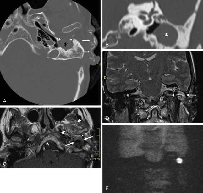 Fig. 6.2, Congenital cholesteatoma of the external auditory canal (EAC) breaking through into the left temporomandibular joint. A 56-year-old female with prior surgery for an external ear atresia now presents with pain at mastication. (A) Axial CT image at the level of the left temporomandibular joint and the hypotympanum. Note the reconstructed external ear ( arrows ). Instead of an EAC, a sharply delineated punched-out nodular lesion ( asterisk ) is seen at the expected location of the EAC. Note the communication between the lesion and the left temporomandibular joint ( arrowheads ). On this image, further characterization of this lesion cannot be done. (B) Coronal CT reformation at the level of the left protympanum. On the expected location of the EAC, a large and sharply delineated punched-out soft tissue lesion ( asterisk ) is found. (C) Axial delayed gadolinium-enhanced T1-weighted MR image (same level as in A ). Note the mixed hypo- to isointensity of the lesion ( arrows ), with some peripheral enhancement. There is a communication with the left temporomandibular joint ( small arrowheads ), with enhancement of the left temporomandibular joint and masticator muscles ( large arrowheads ). (D) Coronal T2-weighted MR image (same level as in B ) shows the moderate to high intensity of the lesion ( arrows ). (E) b 1000 non-EP diffusion-weighted MR image clearly shows the hyperintensity of the lesion in the signal void of the left temporal bone. This hyperintensity is pathognomonic for a cholesteatoma. Final diagnosis based on imaging was a probable congenital cholesteatoma with secondary infection and breakthrough in the left temporomandibular joint. Surgery confirmed these findings.