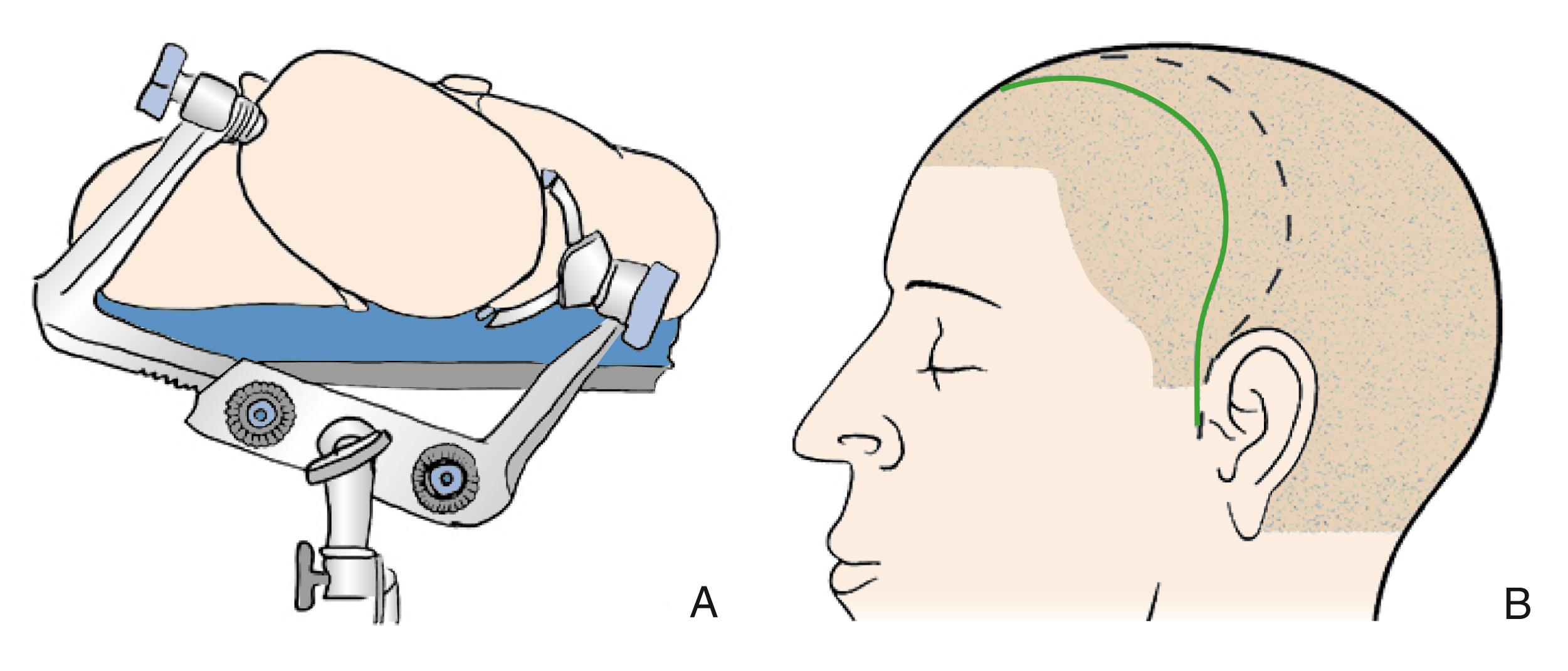 FIGURE 100.1, Patient positioning and incisional marking for temporal lobectomy. (A) Patient is positioned supine and head fixated with the nose elevated 20 degrees above the horizontal sagittal plane. (B) A frontotemporal curvilinear incisional mark is preferred. In a left-sided approach, a straighter curve is made (solid line) , however, a larger curve with greater exposure is pursued in right-sided surgery (dashed line) .