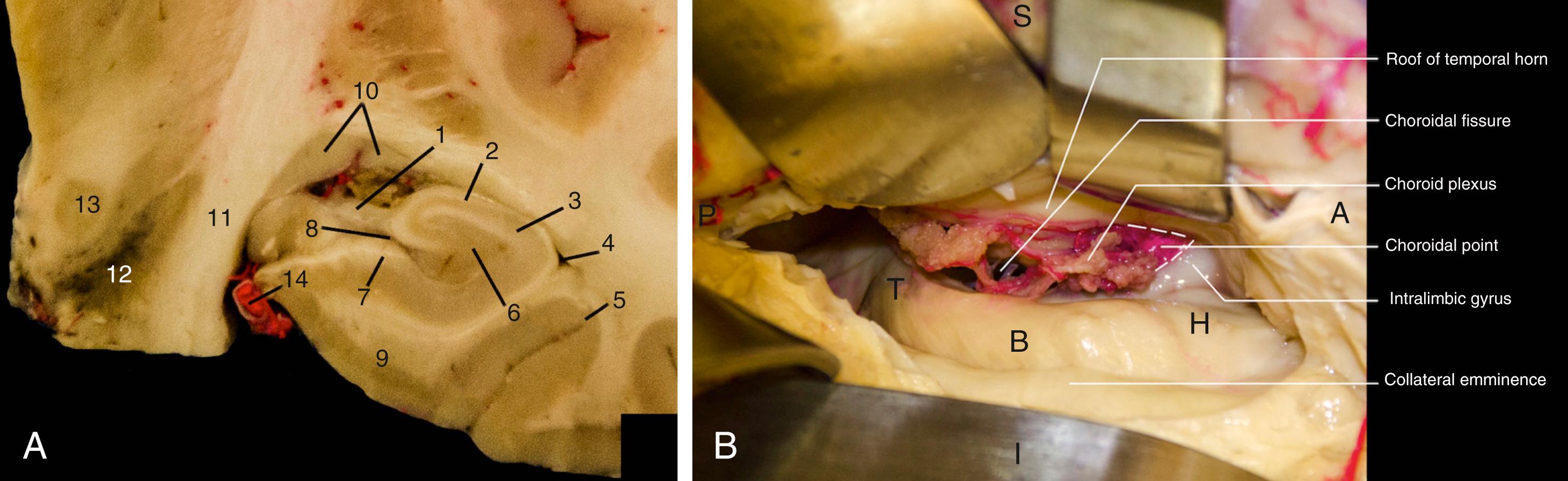 FIGURE 100.4, (A) Coronal cross-section of the left temporal lobe. The lateral wall of the hippocampus is in the temporal horn (4) . Note the relationship of the collateral sulcus (5) bulging into the temporal horn, the collateral eminence. Inferiorly, the hippocampus is surrounded by the parahippocampal gyrus (9) . The hippocampus proper is composed of the dentate gyrus (6) , CA4 and 3 regions, as well as the CA2 (2) , and CA1 (3) regions. The hippocampal sulcus (8) divides the hippocampus from the parahippocampal gyrus. The fimbria and fornix (1) carry the outflow of information from the hippocampus. 1 , Fornix; 2 , CA2 region; 3 , CA1 region; 4 , temporal horn; 5 , collateral sulcus; 6 , dentate gyrus; 7 , subiculum; 8 , hippocampal sulcus; 9 , parahippocampal gyrus; 10 , medial and lateral geniculate nuclei; 11 , cerebral peduncle; 12 , substantia nigra; 13 , red nucleus; 14 , posterior cerebral artery. (B) Right temporal horn demonstrating the structures of the mesial temporal lobe as viewed during surgery. The middle temporal gyrus has been opened and subcortical white matter dissected, with retractors placed on the roof of the temporal horn. When entering the temporal horn, the hippocampus is seen as a bulging structure with a crescent shape. The hippocampal head is wide and approximately 15 mm in length (H) , containing digitations on its surface. The body (B) of the hippocampus begins at the choroidal point and is approximately 10 mm in length before narrowing and blending posteriorly to the tail. The tail (T) wraps around the ambient cistern into the trigone of the ventricle. The dorsal border of the hippocampus is formed by the choroidal fissure, an important landmark. The intralimbic gyrus is a rectangular structure that is identified immediately anterior to the velum terminale, as shown. The velum terminale is a thin triangular-shaped membrane that is formed by the fibers of the fimbria and stria terminalis. This is also known as the inferior choroidal point. Immediately posterior to this structure is the choroidal point, a thin pinkish membrane that is visible upon retraction of the choroid plexus. The choroidal point is an extremely consistent structure which marks the entry point of the anterior choroidal artery. Its identification is one of the first steps after entering the temporal horn.