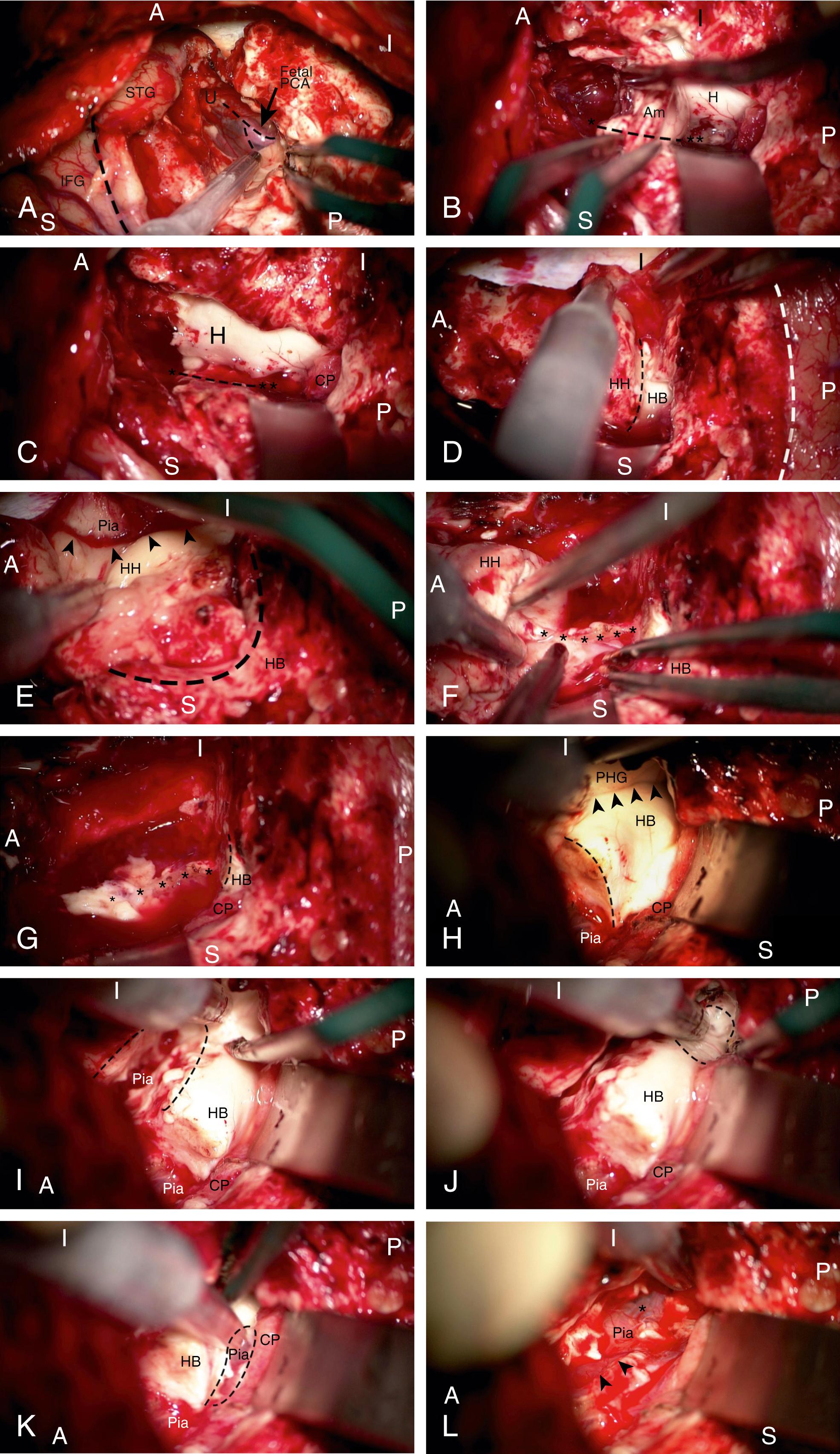 FIGURE 100.6, Intraoperative steps of right-sided amygdalohippocampectomy after completion of neocortical resection. A , anterior; I , inferior; P , posterior; S , superior. (A) Defining the antero-superior border of amygdala resection. The sylvian fissure (dotted line) , inferior frontal gyrus (IFG) and partially removed superior temporal gyrus (STG) are seen. The mesial pia is now visible after complete resection of the anterior uncus (U) . The M1 segment is visible through the pia, which marks the antero-superior border of the resection. Once identified, the location is marked and attention is now turned to the temporal horn further posteriorly. (B) A panoramic view including the temporal horn with a retractor placed along the roof to protect the contents including the fibers of the optic radiation. The hippocampal head (H) is visible. Once choroidal point and velum terminale are identified, the intralimbic gyrus is readily identifiable as the next anterior anatomical structure. The intralimbic gyrus is aspirated subpially (∗∗). This marks the posterosuperior border of amygdala resection and also serves as a medial landmark during amygdala resection. A line drawn (dotted line) from the intralimbic gyrus (∗∗) to the location of M1 (∗) is demonstrated by the bipolar forceps as the resection line for the amygdala. (C) The same view as B after resection of amygdala. The head of the hippocampus (H) is now readily visible. (D) Attention is now turned more posteriorly in order to resect the hippocampal head. Superficially, the posterior extent of neocortical resection is shown (white dotted line) . Intraventricularly, the hippocampal head (HH) is severed (black dotted line) in the coronal plane from the body (HB) . (E) Next the HH is laterally peeled off the pia (arrowheads) . The coronal resection line and the hippocampus body (HB) are visible. (F) Attention is now turned to the medial side of the HH where the hippocampal sulcus (∗) is identified and carefully coagulated and divided along the long axis of the hippocampus. This step leads to complete separation of the HH. (G) The resection cavity after removal of the HH. The hippocampal sulcus remnant (∗) and mesial pia are seen. CP , choroid plexus. (H) Now attention is turned posteriorly and the retractor is adjusted along the axis of the temporal horn to remove the hippocampus body (HB) . In this view, the collateral eminence (arrowheads) and the remainder of the parahippocampal gyrus (PHG) are seen. The dotted line shows the coronal resection line of the body from the now removed HH. (I) The HB is first separated subpially on the lateral side (black dotted lines) . (J) Next the HB is severed from the tail by aspiration as shown (black dotted lines) . (K) Lastly, attention is turned medially. The hippocampal sulcus is identified, coagulated, and divided along the axis of the HB (black dotted lines) , allowing its complete removal. L) After removal of the HB, the medial pia is visible. The ambient cistern (∗) and the posterior cerebral artery (arrowheads) can be seen through the pia.