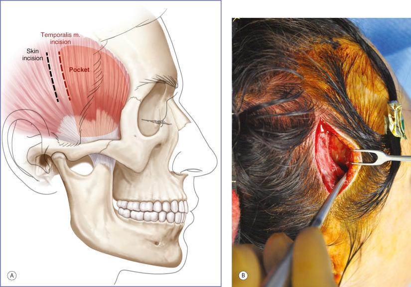 Fig. 6.2, Surgical incisions to access implant material beneath temporalis muscle. ( A ) Staggered scalp incisions and temporalis muscle incisions to avoid suture lines overlying implant. ( B ) Exposure of space between temporal muscle and temporal fossa.