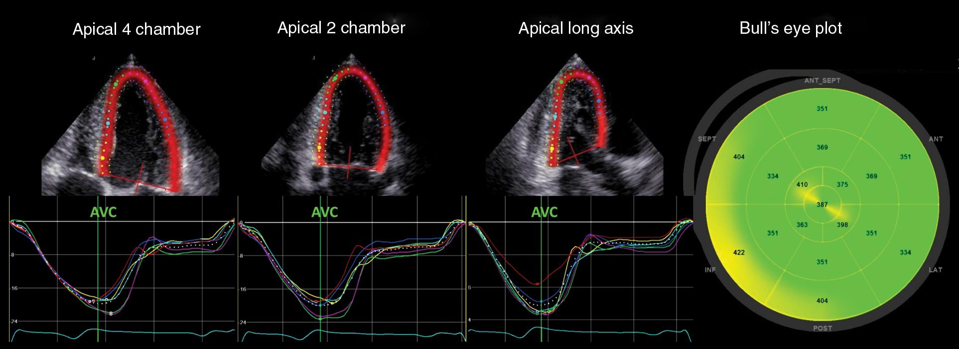 Fig. 5.1, Healthy 33-year-old male patient with normal synchronous contractions timed around aortic valve closure (AVC) and low mechanical dispersion (30 ms). The uniform color of the bull’s-eye plot illustrates low difference in segmental time-to-peak strain.