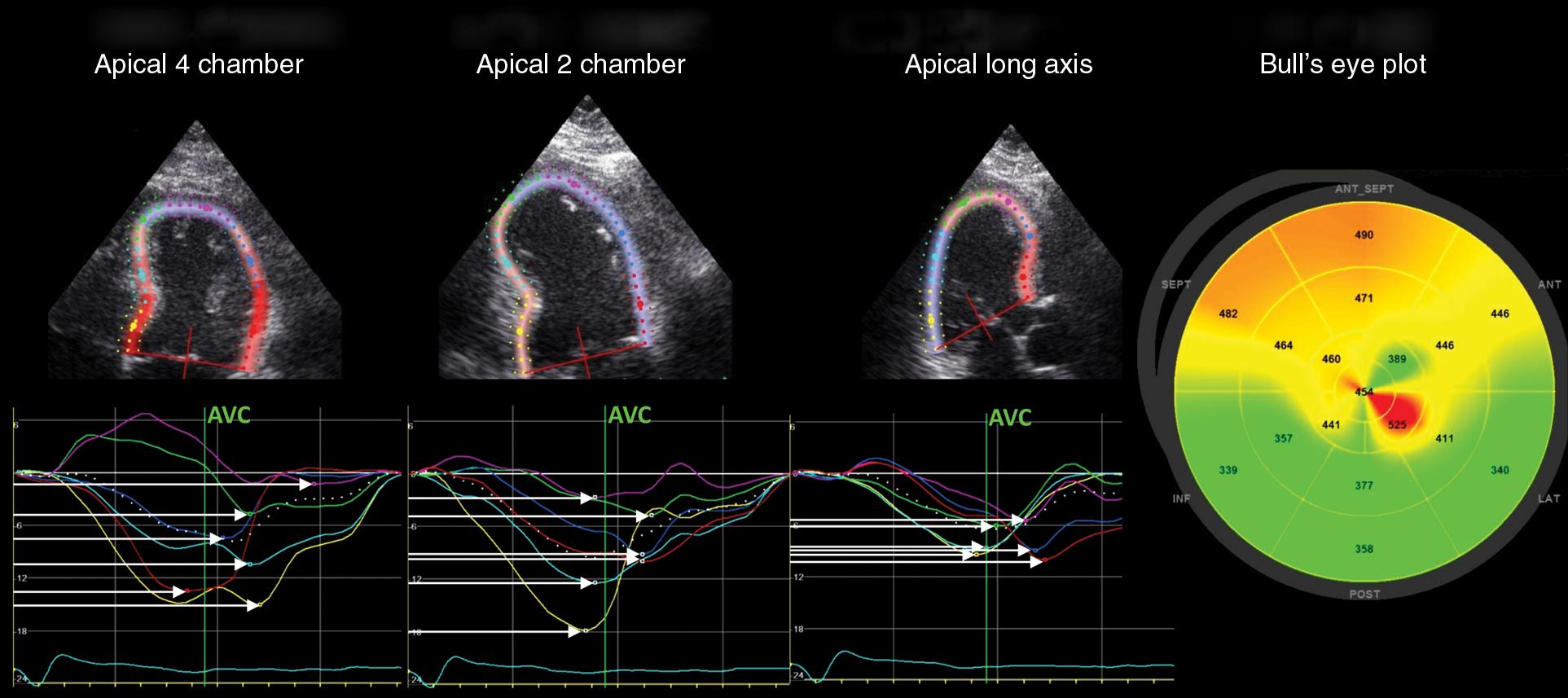 Fig. 5.2, A 52-year-old male patient with acute myocardial infarction due to occlusion of the left anterior descending coronary artery. The white horizontal arrows illustrate heterogeneous segmental contraction durations and pronounced mechanical dispersion (66 ms). The color difference of the bull’s-eye plot illustrates difference in segmental time-to-peak strain. AVC, Aortic valve closure.