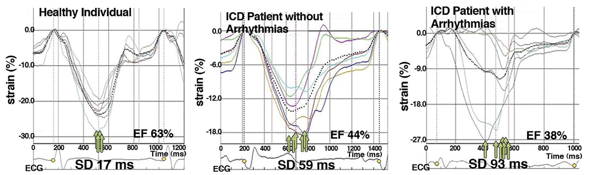 Fig. 5.3, Association of mechanical dispersion with arrhythmias. Strain echocardiograms in a healthy individual (upper left) and post–myocardial infarction patients with implantable defibrillators with (lower panel) and without (upper right) arrhythmias during follow-up. The timing of maximum myocardial shortening in each segment is shown by green arrows , and the average myocardial shortening for each patient is shown by the dotted line . EF , ejection fraction; ICD , implantable cardioverter defibrillator; SD , standard deviation.