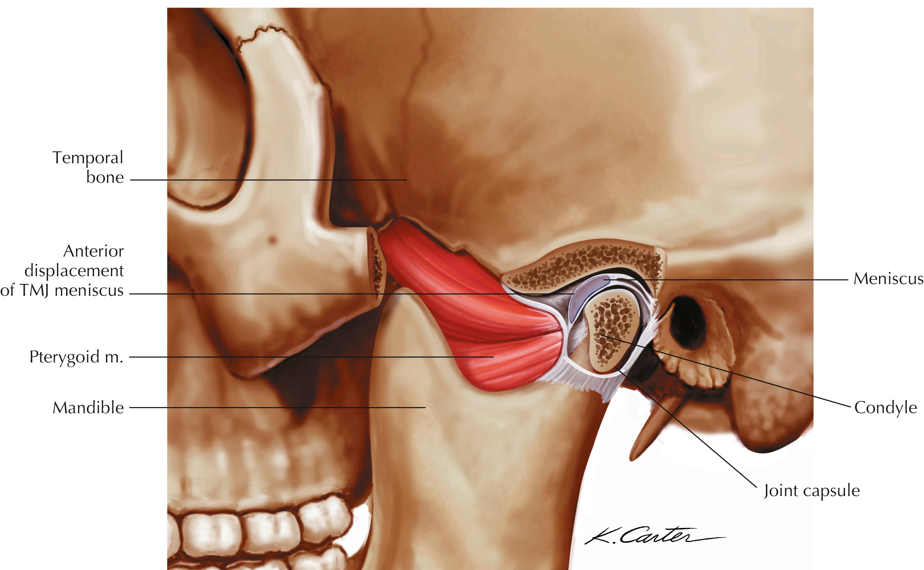 Figure 2-14, Anterior disc displacement.