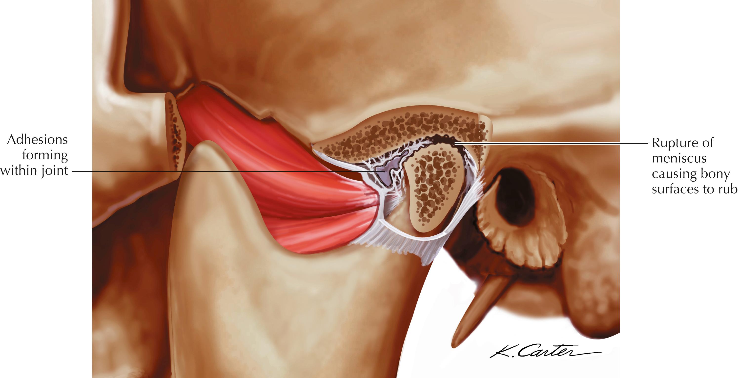 Figure 2-15, Temporomandibular arthrosis.