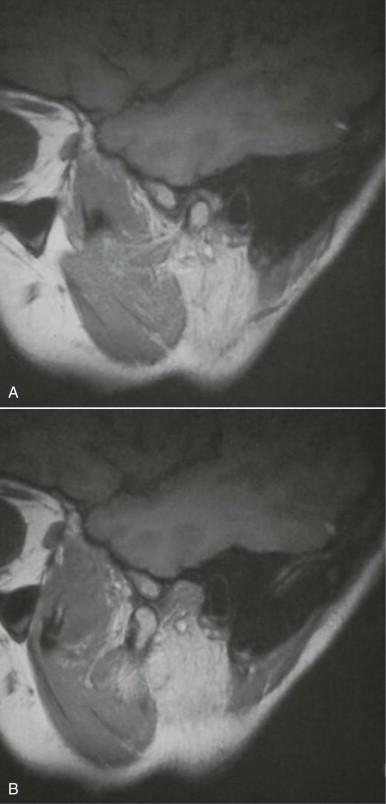 Figure 10-1, A, T1-weighted MRI scan in the closed mouth position showing anterior disk displacement. B, T1-weighted MRI scan in the open mouth position showing recapture or reduction of the disk.