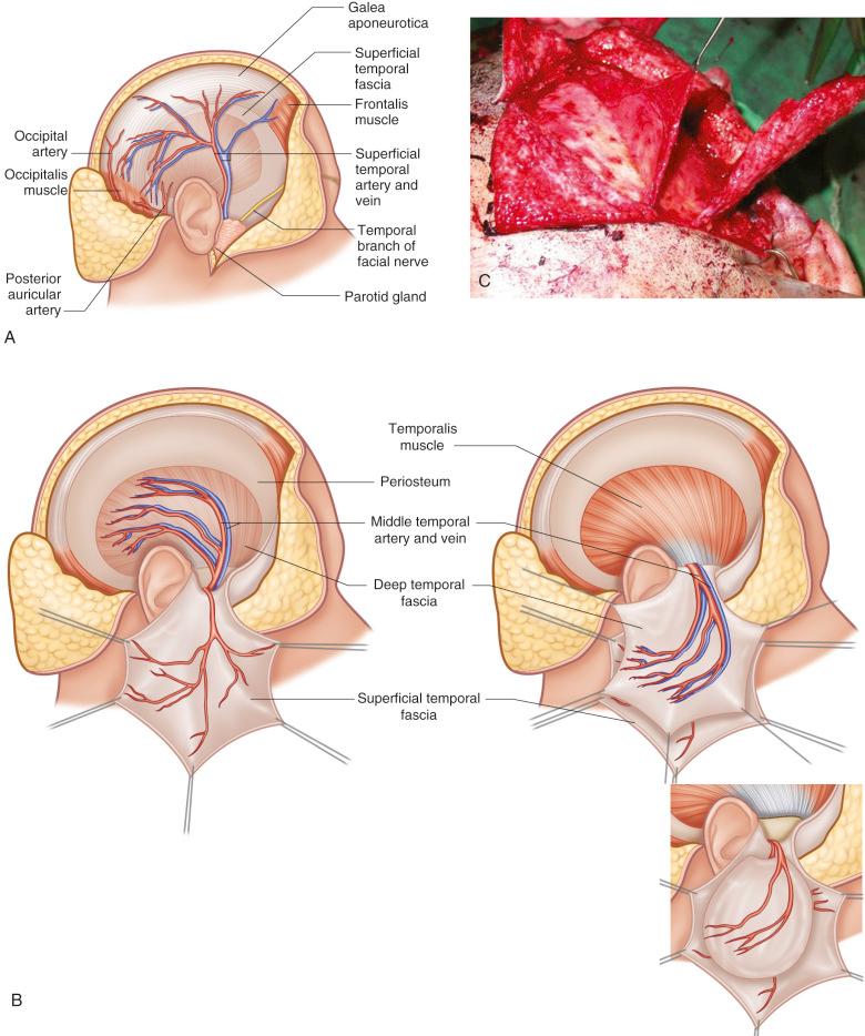 Figure 32.2, (A) Regional anatomy of the temporoparietal area. The TPF fascia is a continuation of the SMAS. The TPF is also continuous with the galea superiorly, frontalis muscle anteriorly, and occipitalis muscle posteriorly. The STA and vein arborize above the zygomatic arch to give rise to an anterior and a posterior branch. The posterior branch may have connections with the posterior auricular artery and occipital artery. (B) The TPF (also referred to as the superficial temporal fascia) and the deep temporal fascia are separate and distinct layers partitioned by a loose areolar layer. The TPF has been divided at its superior margin and reflected inferiorly to show the deep temporal fascia. The deep temporal fascia receives its blood supply from the middle temporal artery, a branch of the STA. (C) Clinical case showing the areolar layer, or innominate fascia, as a separate vascularized layer that is located between the superficial and deep temporal fascia.