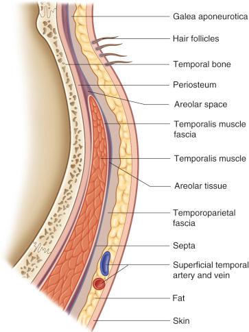 Figure 32.3, Coronal section of the temporal fossa showing the relation of the TPF to the scalp and deep temporal fascia. Note the close proximity of the hair follicles to the TPF. The vessels are located within or just external to the TPF fascia and thus may be inadvertently injured during dissection. A loose areolar layer separates the TPF from the deep temporal fascia.