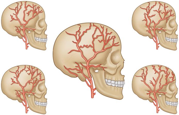Figure 32.4, Five most common branching patterns of the superficial temporal artery. The most common pattern is seen in the center, where the bifurcation of the STA occurs above the zygoma.