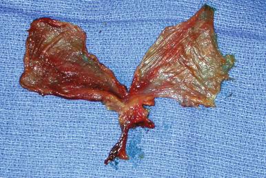 Figure 32.5, Double-layered fascial flap utilizing both the TPF and deep temporal fascia. The deep temporal fascia is supplied by the middle temporal vessel branching from the STA just superior to the zygomatic arch.