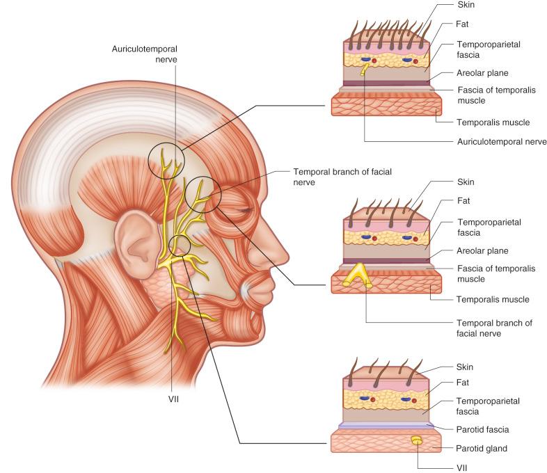 Figure 32.6, Anatomic course of the ATN and temporal branch of the facial nerve. The ATN runs superficial to the TPF while the temporal branch of the facial nerve runs on the deep surface of the TPF.