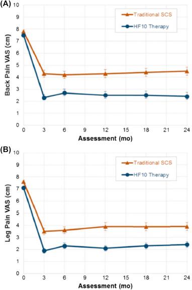 Figure 54.2, Comparison of long-term chronic back (A) and leg (B) pain score changes when traditional ( red triangles ) or 10 kHz HF SCS ( blue circles ) were used. Significant improvements are maintained at 24 months after an implant with 10 kHz HF SCS (marked as HF-10 therapy in graph), superior to traditional SCS. Note the significant attrition of positive pain control effect over time for traditional SCS. Despite similar trial-to-implant conversion rates and minimal differences in outcomes at 1 month, at 3 months there is significantly more loss of efficacy for traditional low-frequency stimulation. mo , months; VAS , visual analog scale.