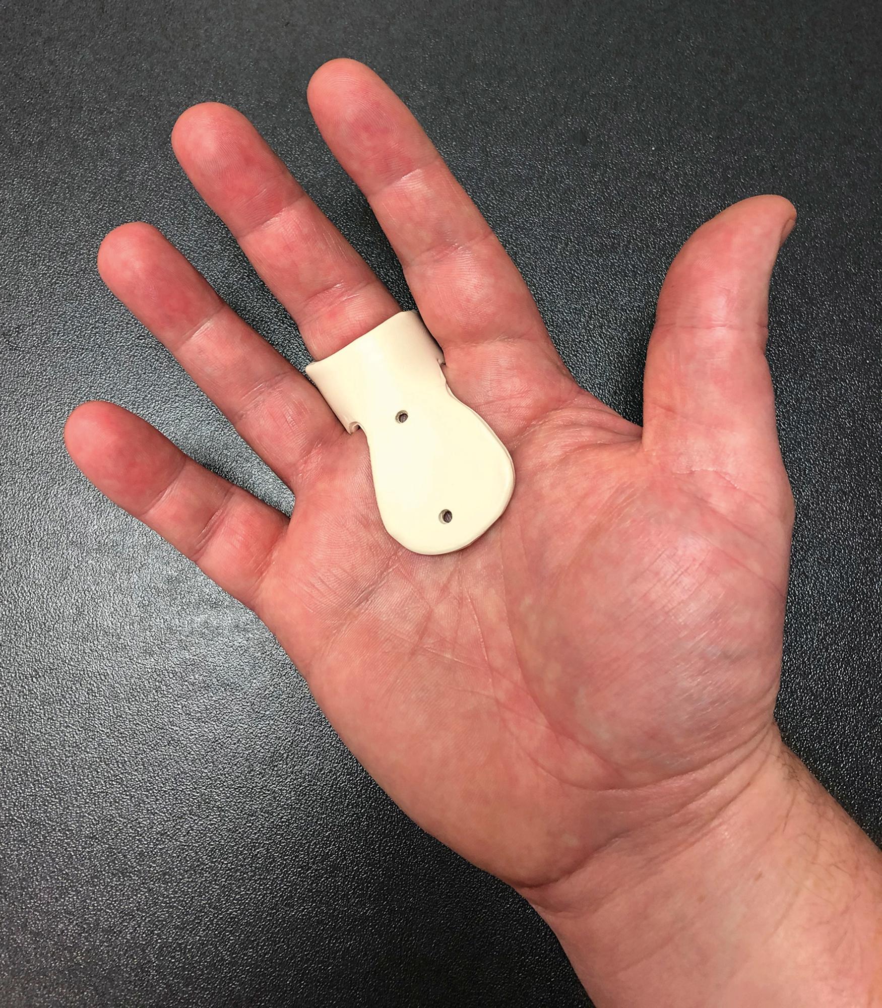 Fig. 56.3, Custom orthotic for prevention of MCP flexion to treat trigger digit.