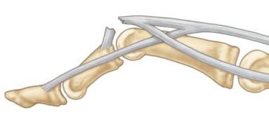 Fig. 73.3, Boutonnière deformity resulting from a central slip rupture with distal interphalangeal joint hyperextension.