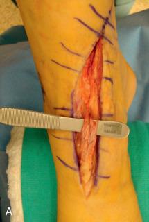 Fig. 118.2, (A) Intraoperative photograph of chronic insertional anterior tibial tendon rupture prior to débridement. (B) After looped semitendinosis allograft reconstruction with insertion into the medial cuneiform and lateral cuneiform.