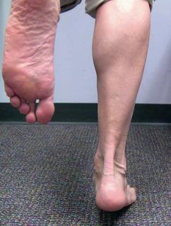 Fig. 118.3, This patient is able to perform a single-limb heel rise, indicating the intact function of the posterior tibial tendon. Patients with stage I disease can perform this test, but it is very painful to do so.