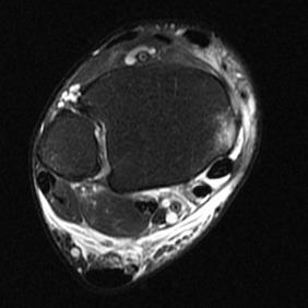 Fig. 118.4, An axial T2-weighted magnetic resonance image of a subacute ankle injury. Note the posteromedial tibial bone edema, fluid within the posterior tibial tendon sheath, and the anterior false pouch where the posterior tibial tendon previously dislocated.