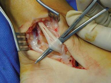 Fig. 118.5, A longitudinal split tear in the posterior tibial tendon can be seen in stage I disease. This tear should be treated with débridement and tubularization of the tendon. If any evidence is seen of hindfoot valgus, excision and tendon transfer with the addition of a calcaneal osteotomy should be considered.