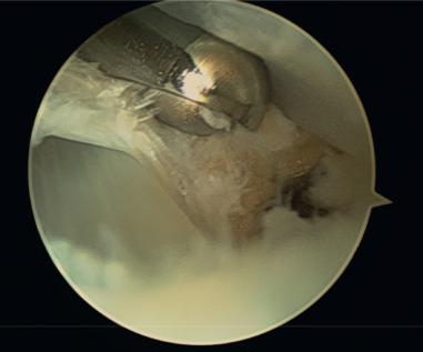 Fig. 118.6, View of posterior tibial tendoscopy showing débridement of tenosynovitis using arthroscopic shaver, with fibrotic band around the tendon.