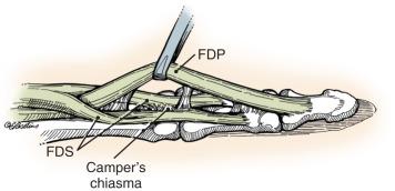 FIG. 2.3.1, Anatomy of the flexor tendons of the fingers.