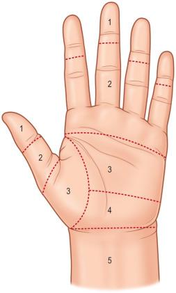 FIG. 2.3.3, The flexor tendons are divided into five zones according to their underlying anatomical structures.