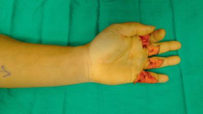 FIG. 2.3.8, This man suffered complete lacerations of the FDP and FDS tendons to the middle, ring, and small fingers. Note the posture of these fingers in complete extension. He also suffered partial laceration of the flexor tendons to the index finger. Note that there is still some resting flexion of the index finger.
