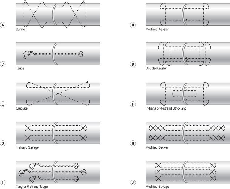 FIG. 2.3.10, Various techniques for placement of core sutures.