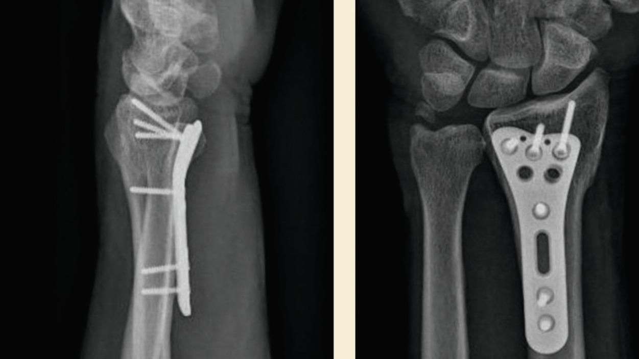 Fig. 1, Preoperative radiographs show a standard volar locking plate slightly proud to the volar rim, classified as Soong grade 1.