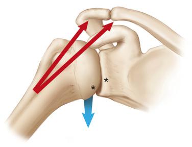 FIG. 41.1, Force across the shoulder, which predisposes the shoulder to vertical imbalance. Red arrows show the cranial force of the deltoid muscle. Blue arrow shows the force of the rotator cuff muscles to balance the shoulder, and in case of insufficiency, the resulting strength is cranial and leads to pseudo paralysis. The asterisks demonstrate the progressive cartilage wear leading to rotator cuff arthropathy over time.