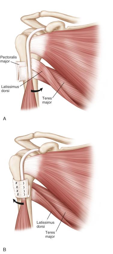 FIG. 41.4, (A and B) Demonstrate the position of the latissimus dorsi/teres major tendons before transfer (A) and after transfer (B) and post-transfer latissimus dorsi tendon only.