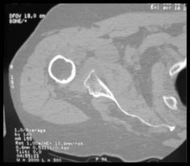 FIG. 41.10, Computed tomographic axial cuts demonstrate complete rupture, fatty infiltration, and retraction of the teres minor.