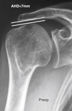 FIG. 41.8, Decreased acromiohumeral head distance (AHD).