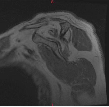 FIG. 41.9, Magnetic resonance imaging parasagittal cuts demonstrate atrophy and fatty infiltration of the supraspinatus, infraspinatus, and teres minor muscles.