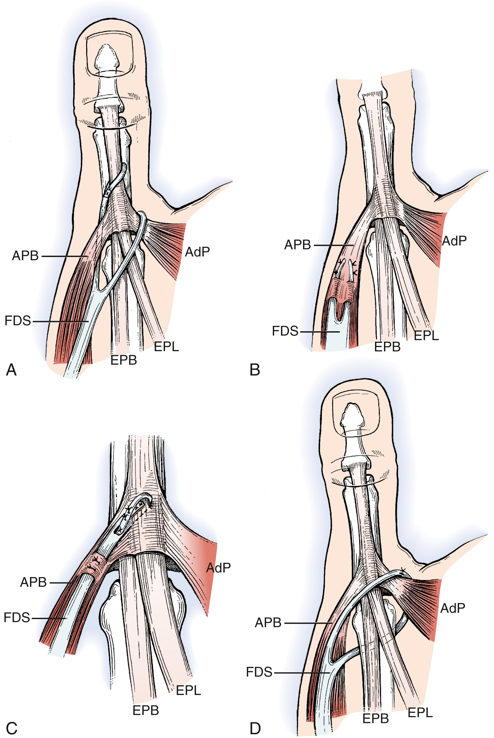 Fig. 31.1, A-D, Techniques of distal attachment as described by Brand, Littler, Riordan, and Royle-Thompson. AdP, Adductor pollicis brevis; APB, abductor pollicis brevis; EPB, extensor pollicis brevis; EPL, extensor pollicis longus; FDS, flexor digitorum superficialis.