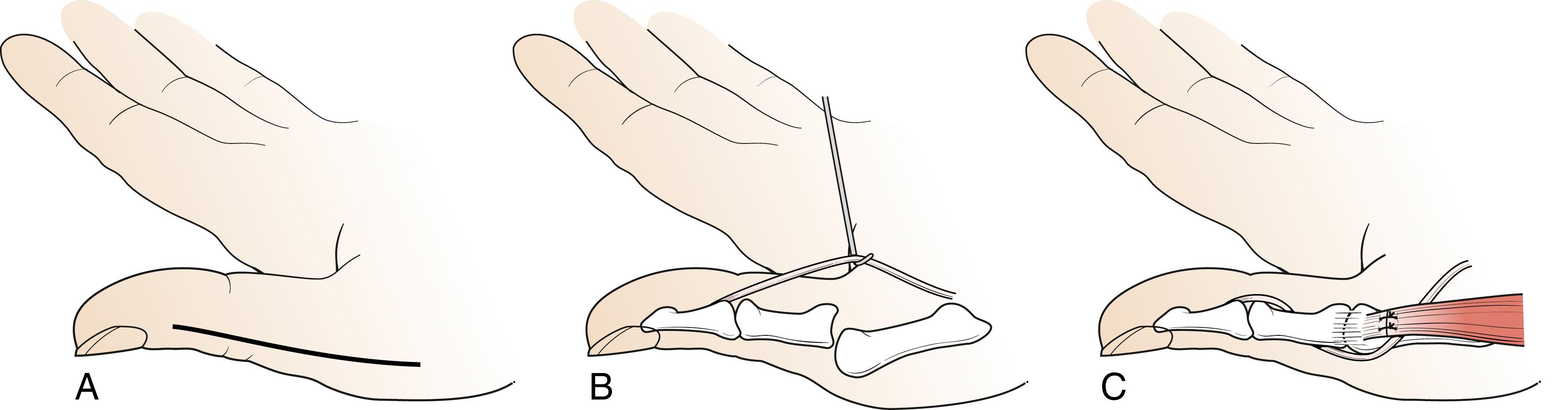 Fig. 31.11, Oberlin’s flexor pollicis longus (FPL) opponensplasty. A, A longitudinal incision is made on the radial aspect of the thumb. The radial neurovascular bundle is protected, and the flexor sheath is released throughout its length to allow retraction of the FPL tendon. B, The soft tissue attachments to the proximal phalanx are released circumferentially from its neck distally to the metacarpophalangeal (MCP) joint; then the joint capsule is completely divided and the FPL tendon is passed through it so that distally it passes around the ulnar border of the shaft of the proximal phalanx. It then runs over the extensor surface of the MCP joint before passing radially over the neck of the metacarpal. C, The MCP joint is then fused and stabilized until union. The position of the FPL can be fixed on the radial aspect of the neck of the metacarpal by dividing the insertion of abductor pollicis brevis, placing FPL under the tendon, and then repairing the insertion. This transfer can be performed through the interphalangeal joint rather than the MCP joint, in which case it is the former that is fused; great care must be taken to ensure that the transfer passes over the back of the MCP joint. If it passes over the back of the proximal phalanx, it may flex the MCP joint.