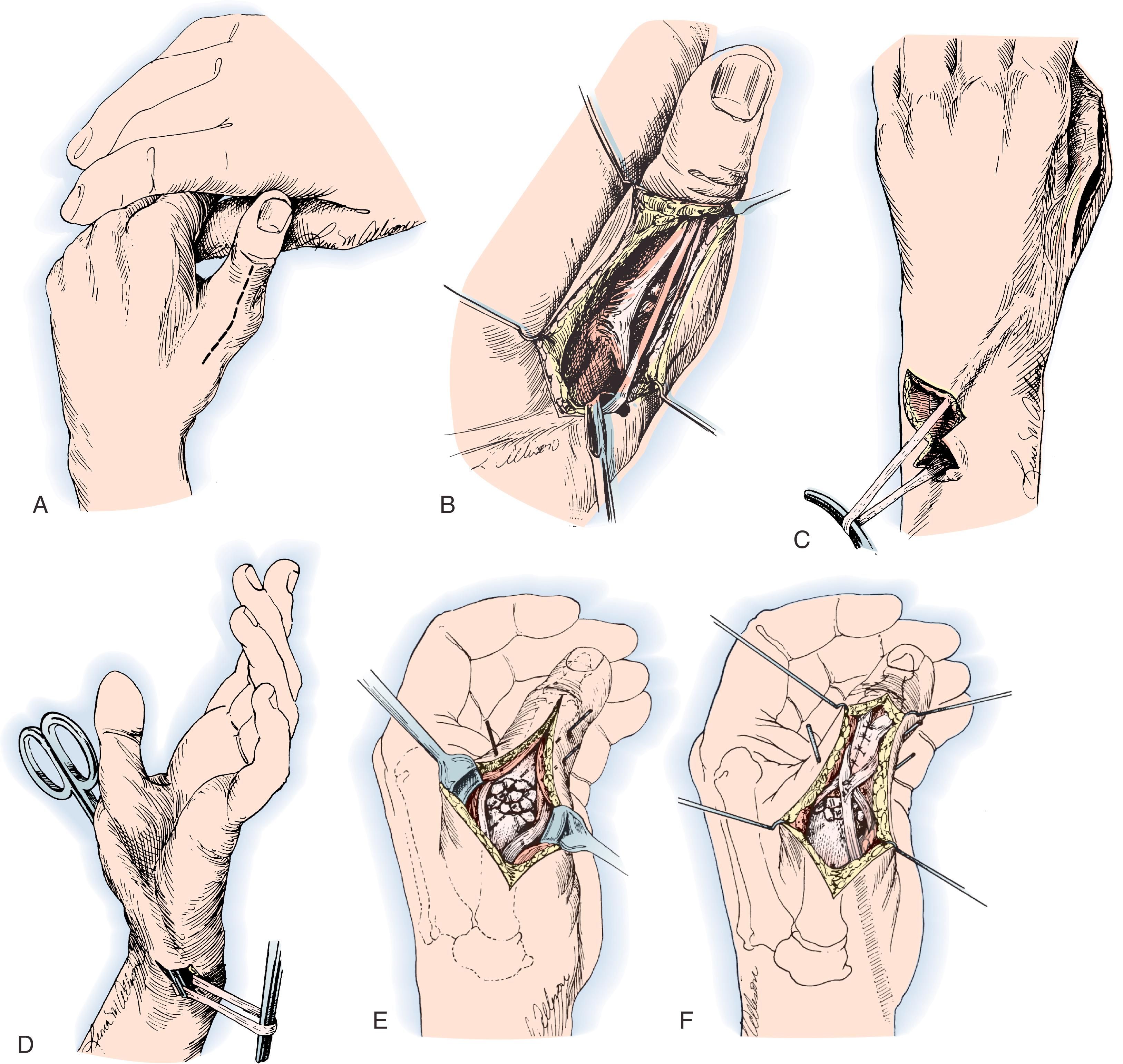 Fig. 31.12, Extensor pollicis longus (EPL) opponensplasty. A and B, The middle portion of the EPL tendon is exposed over the proximal phalanx and removed in continuity with the main EPL tendon proximal to the metacarpophalangeal (MCP) joint. C-E, The transfer is then passed around the ulnar border of the wrist, and the thumb MCP joint is fused. F, The two lateral portions of the EPL tendon over the proximal phalanx are sutured together, and the transfer is sutured around them. The interphalangeal joint is temporarily pinned in extension to protect the transfer while it heals.