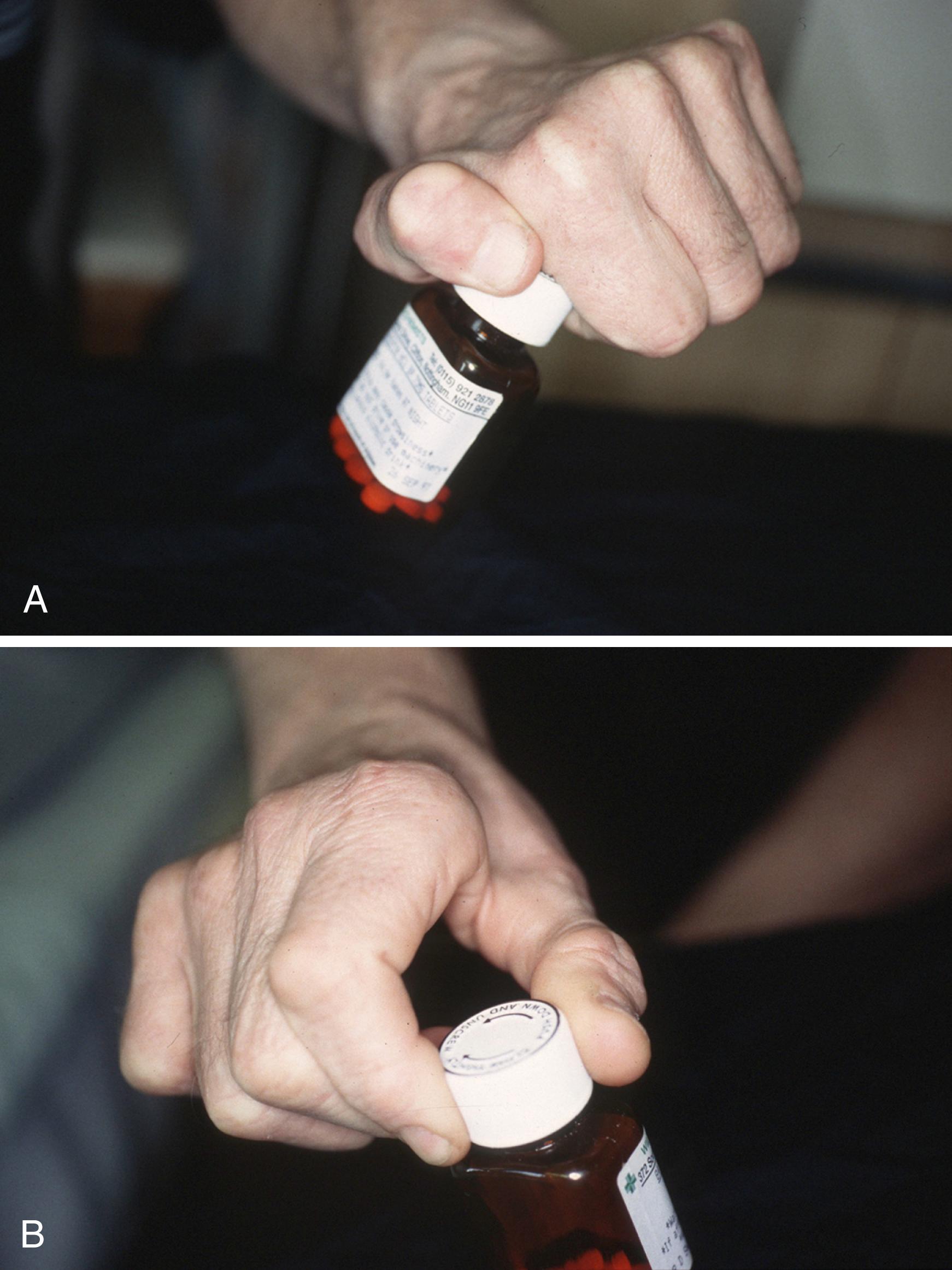 Fig. 31.2, A patient with bilateral T1 neuropathy due to neurologic disease. A, Left hand before extensor indicis proprius (EIP) opponensplasty demonstrating lateral “squeeze” between the retroposed thumb and the side of the index finger. The patient can only pick up objects from a table top with forearm fully pronated. B, Right hand after EIP opponensplasty showing that thumb-to-index pulp pinch is now possible. This allows the patient to pick up objects from flat surfaces without full forearm pronation and allows the person to better see what is being done.