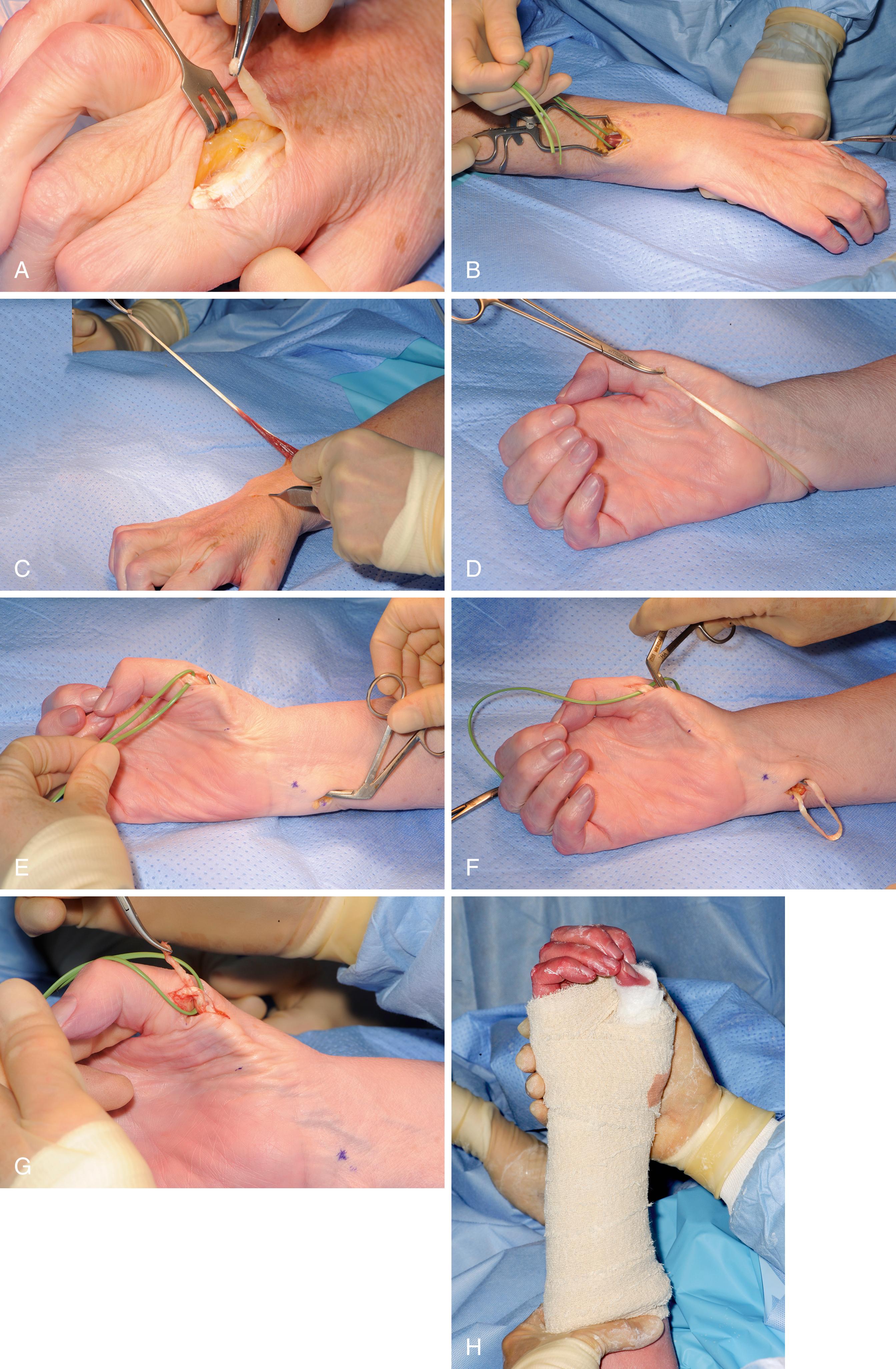 Fig. 31.3, Extensor indicis proprius (EIP) transfer. A, The extensor indicis proprius tendon is harvested from the index finger. The tendon here has been extended by 1 to 2 cm with a slip of the extensor hood. The extensor hood has been repaired but the sutures are hardly visible. B, An incision is made on the dorsoulnar aspect of the distal forearm and the EIP muscle is identified. C, The end of the EIP tendon is passed from the incision at the base of the index finger into the dorsoulnar forearm incision. In my practice this often requires release of soft tissue connections between the index EDC and the EIP, to allow the EIP tendon to be first withdrawn into a third incision on the dorsum of the hand (at the tip of the forceps in this picture). D, The EIP tendon is passed around the ulnar border of the distal forearm to the planned insertion onto the abductor pollicis brevis insertion. I mark the path on the skin to allow accurate placement of the subcutaneous tunnels for the transfer. E, A subcutaneous tunnel is created between one incision on the palmar-ulnar aspect of the distal forearm and another over the abductor pollicis brevis (APB) insertion. The fine blue dots on the skin mark the pathway for the transfer. F, After ensuring the deep fascia over the fourth extensor compartment is widely divided down onto the ulna, the EIP tendon is passed from the dorsoulnar forearm incision into the palmar-ulnar forearm incision. It is then passed subcutaneously across the palm to the abductor pollicis brevis insertion. It must have a straight line of pull around the ulna and across the palm to the APB insertion. G, All the skin incisions for the harvest and transfer of the EIP tendon are closed, and then the EIP transfer is sutured to the APB tendon insertion using a Pulvertaft weave. The tension should be set “rather too tight” than “rather too lax,” as a transfer that is too lax will not work. H, Cyano-acrylate glue can be used to stick the thumb tip to the ring or little fingertip in opposition. A plaster backslab is then applied across the back of the wrist and thumb. This author holds the wrist slight flexion and the thumb opposed to the ring or little fingertip.