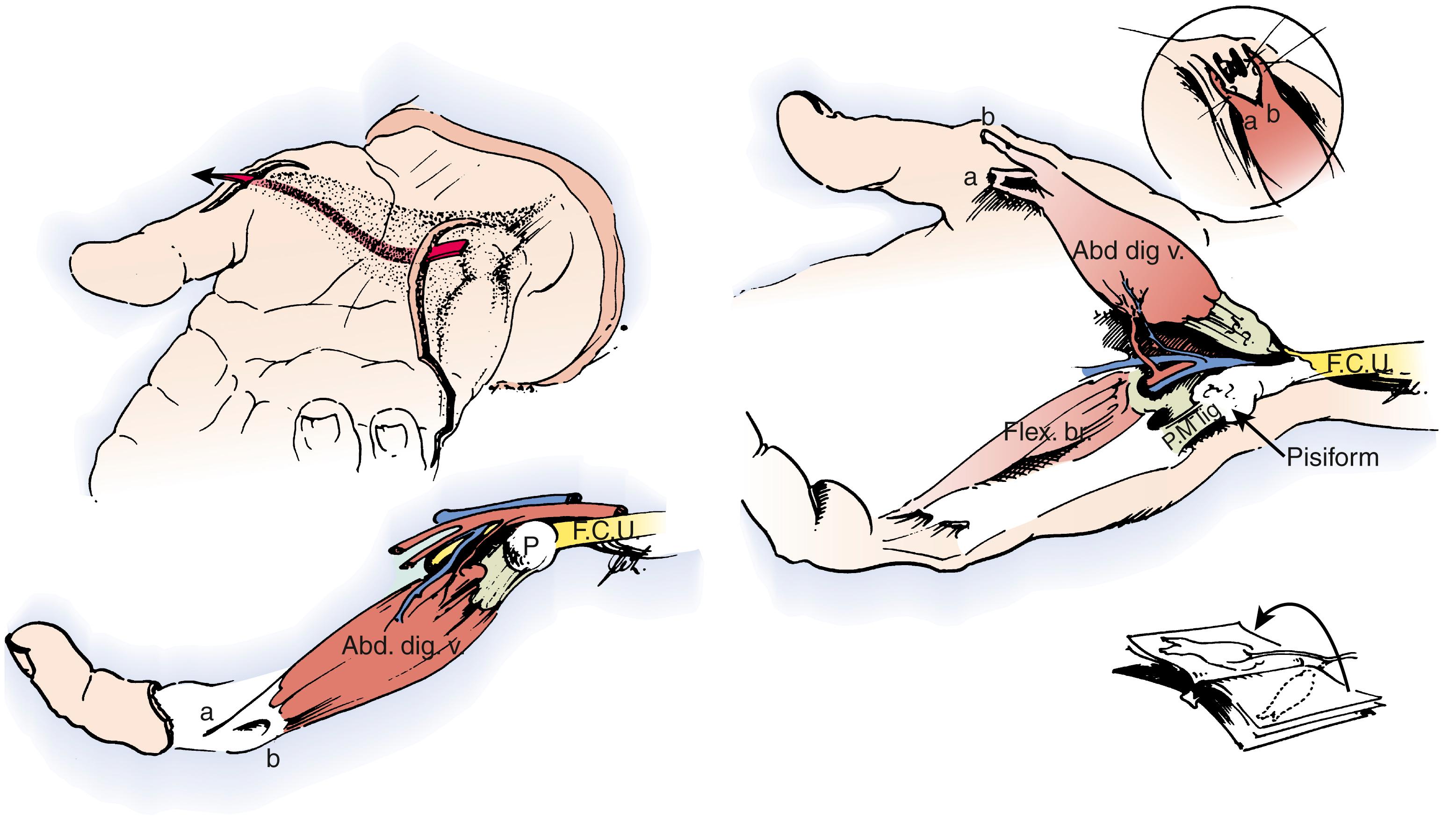 Fig. 31.4, Huber abductor digiti minimi (ADM) opponensplasty. Two incisions are required to expose and transfer the ADM (Abd. dig. v.) . The neurovascular structures enter the muscle proximally on its deep and radial aspect. The muscle is freed from the other hypothenar muscles, and its origin on the pisiform (P) is elevated while preserving a tendinous attachment to the tendon of the flexor carpi ulnaris (F.C.U.) . The ADM is then rotated 180 degrees on its long axis and passed subcutaneously to the area of the thumb MCP joint. The distal attachment is to the APB muscle. Flex. br., Flexor digiti minimi brevis; P.M. lig., pisometacarpal ligament.