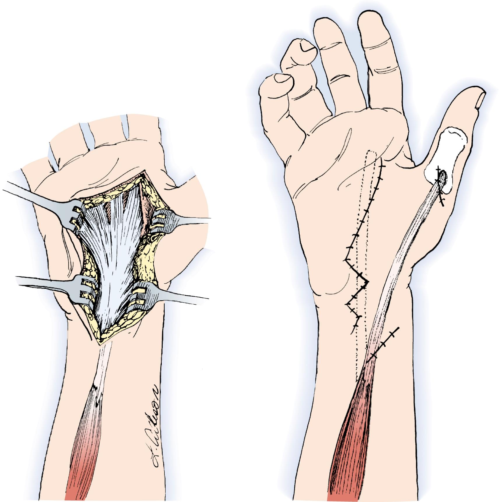 Fig. 31.5, Camitz transfer. The palmaris longus is elongated with a strip of palmar aponeurosis and attached to the abductor pollicis brevis insertion.