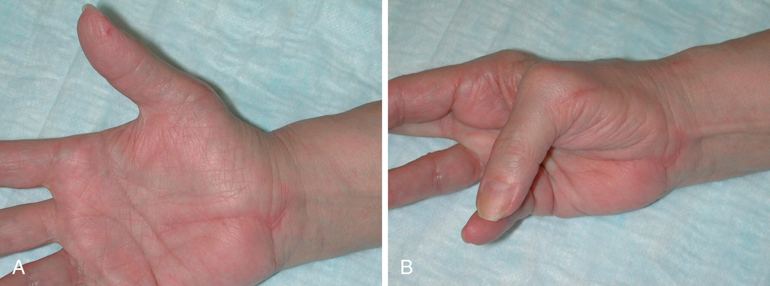 Fig. 31.6, A and B, A patient presented with long-standing carpal tunnel syndrome and thenar muscle atrophy with loss of abduction and opposition. A Camitz transfer was performed at the same time as a carpal tunnel release, and excellent thumb abduction was restored. Thumb pronation was provided by the weak flexor pollicis brevis.